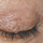 Blefaroplastyka efekty zabiegu