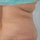 SmartLipo na boki talii