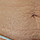 SmartLipo na wiotko�� sk�ry, rozst�py, brzuch