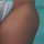 SmartLipo na uda zewn�trzne