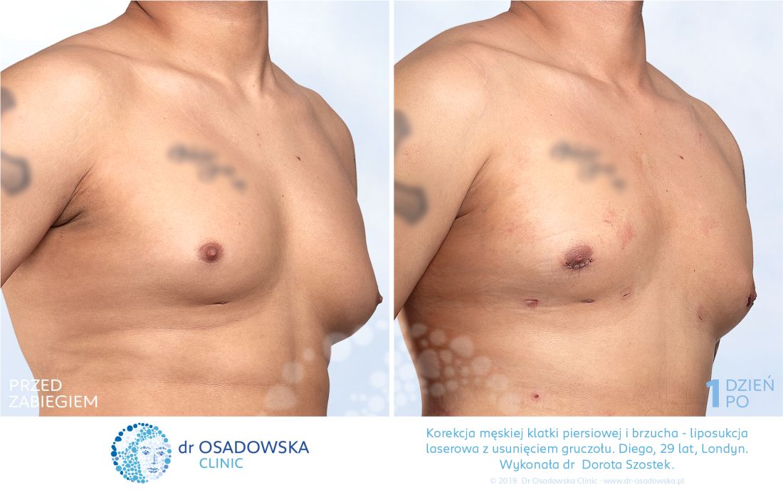 ginekomastia oraz liposukcja laserowa LipoLife męskich piersi. Zdjęcia przed i 1 dzień po zabiegu. Wykonała dr Dorota Szostek. Diego z Londynu. 
