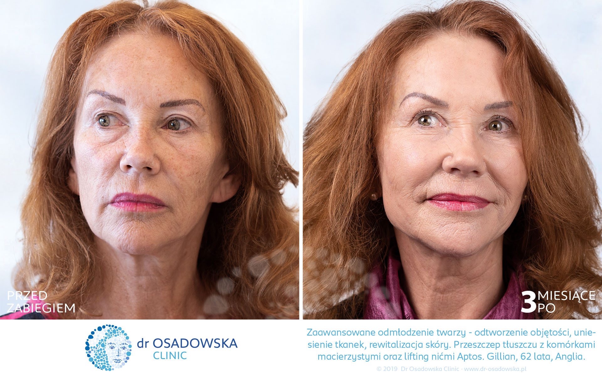 Zdjęcia: odmłodzenie i rewitalizacja twarzy dla Gillian z Anglii, 62 lata. Nici liftingujące Aptos oraz przeszczep własnej tkanki tłuszczowej. Przed i 3 miesiące po zabiegu (1)