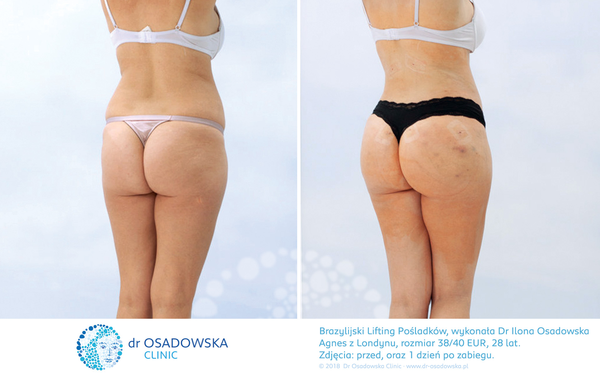 Modelowanie pośladków tłuszczem