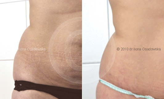 SmartLipo na biodra efekty