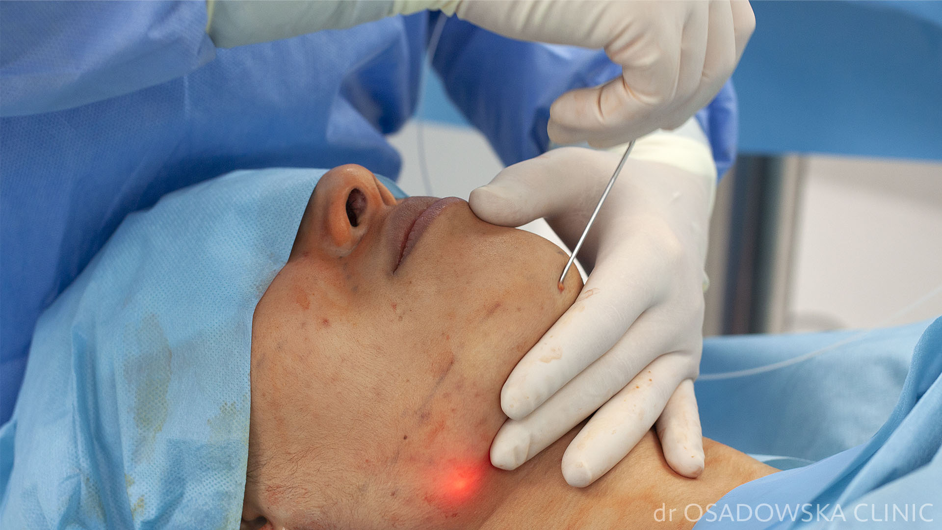 Podbródek - liposukcja laserowa LipoLife. 