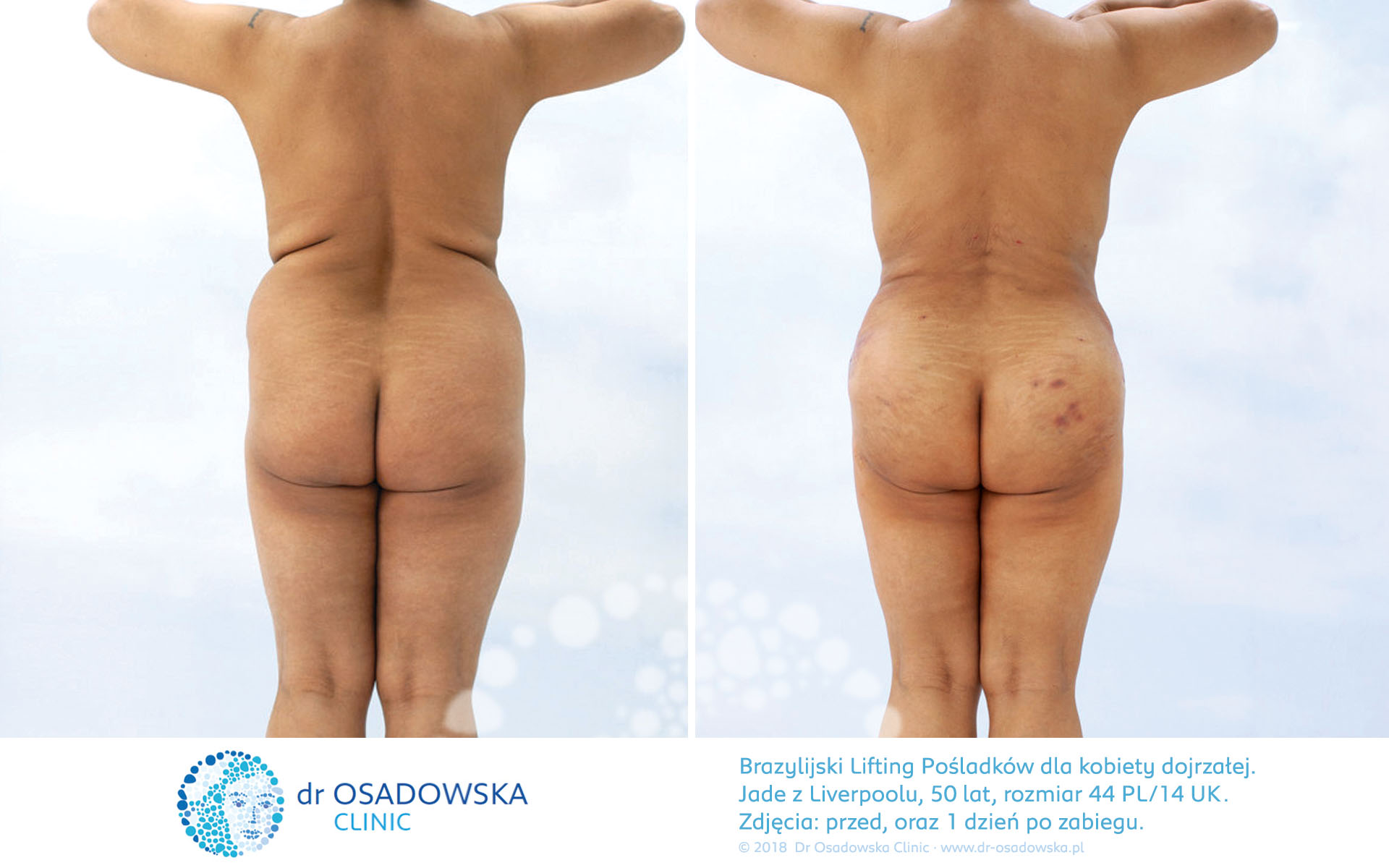 Brazylijski LIfting Pośladków - liposukcja bioder brzucha oraz modelowanie pośladków własnym tłuszczem. Zdjęcia przed i 1 dzień po zabiegu. Liposukcja LipoLife. Wykonała dr Osadowska. Jade z Liverpoolu (A)