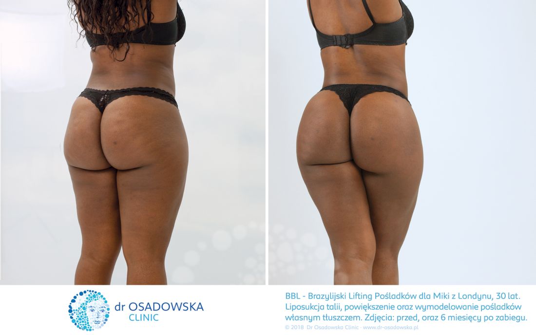 Brazylijski Lifting - powiększenie, modelowanie pośladków tłuszczem. Zdjęcia przed i po zabiegu. Liposukcja laserowa Lipolife, dr Osadowska. Mika, Londyn 03