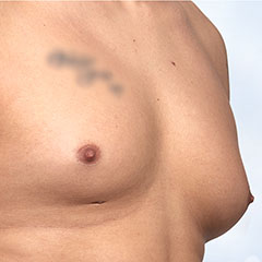 Ginekomastia - chirurgiczne usunięcie gruczołów piersiowych + liposukcja