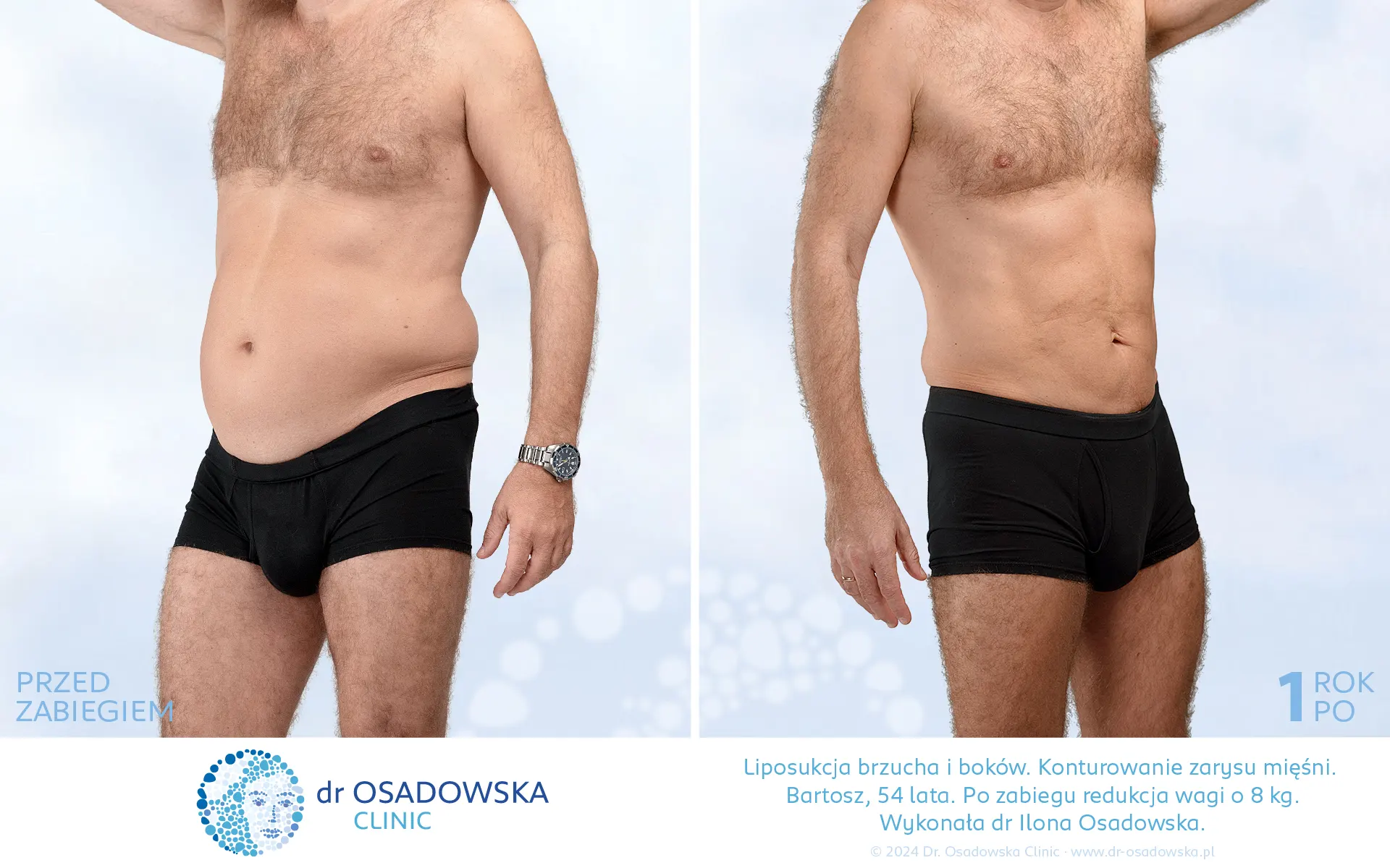 Liposukcja dla mężczyzny z konturowaniem mięśni brzucha. Bartosz. Efekty przed i rok po zabiegu.