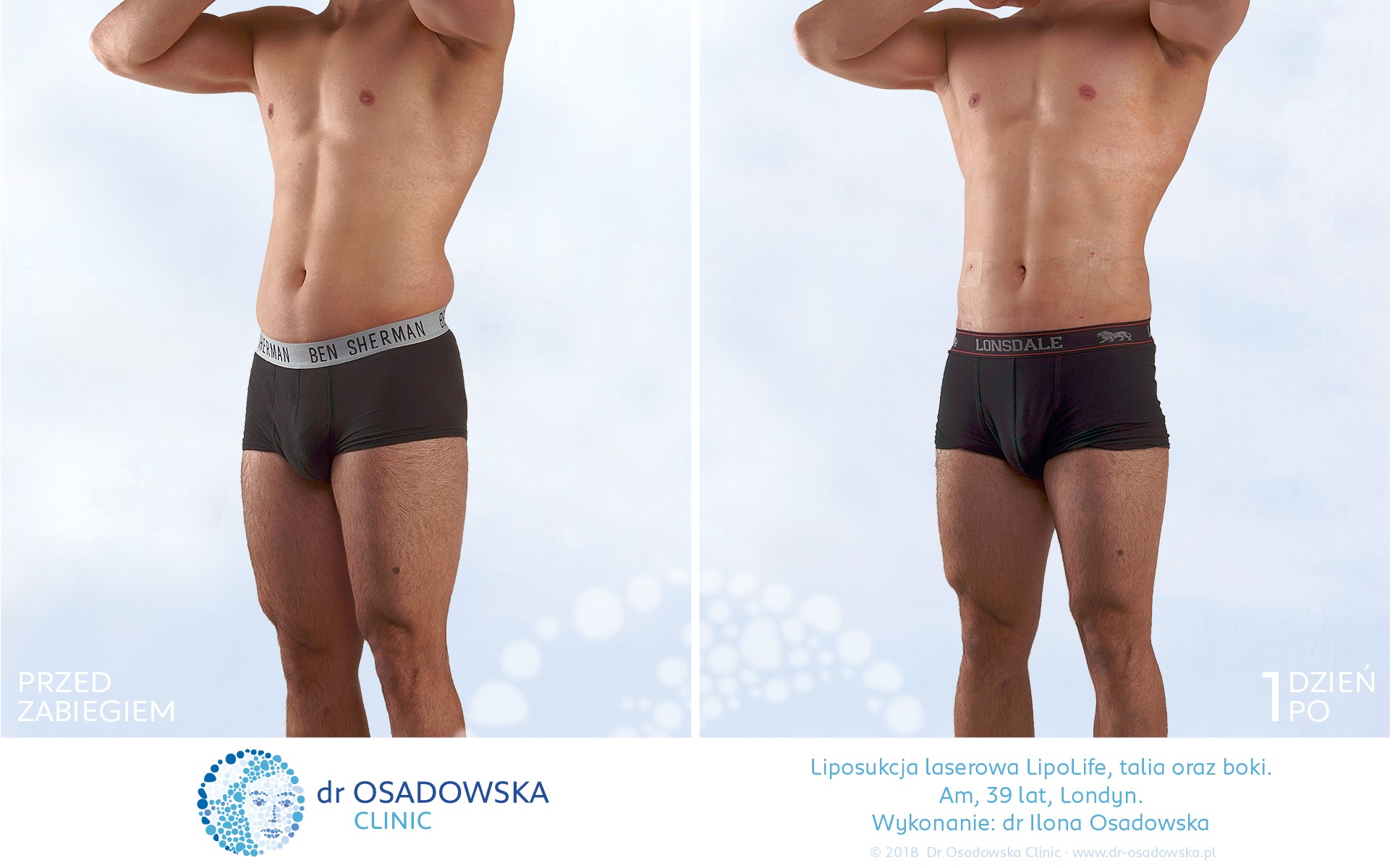 Liposukcja laserowa LipoLife mężczyzna brzuch i boki. Zdjęcia przed i 1 dzień po zabiegu. Wykonała dr Osadowska. Am z Londynu, instruktor fitness. 