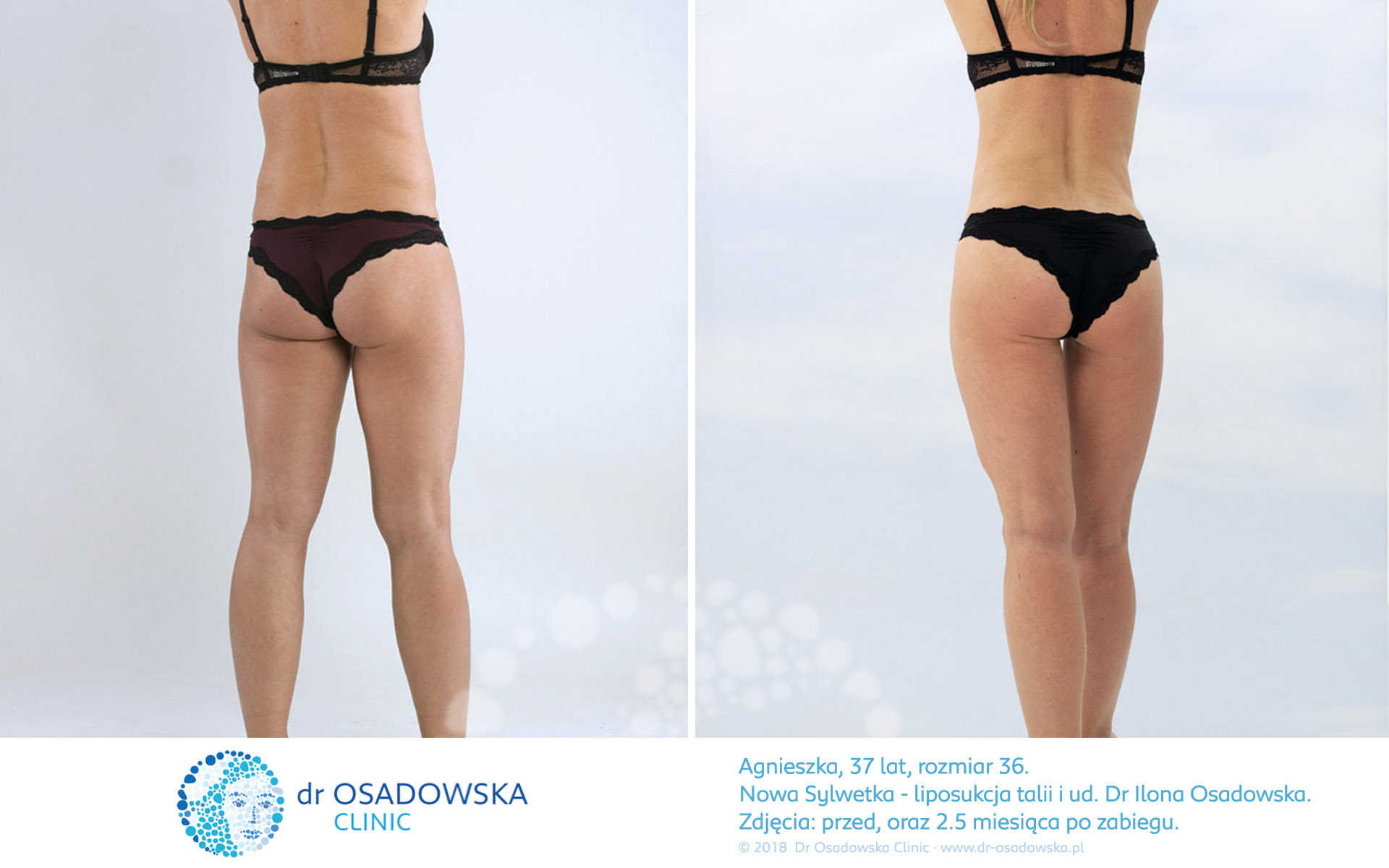 Liposukcja bioder, zdjęcia efekty przed i po zabiegu - 2,5 miesiąca. Lipolife, Dr Ilona Osadowska