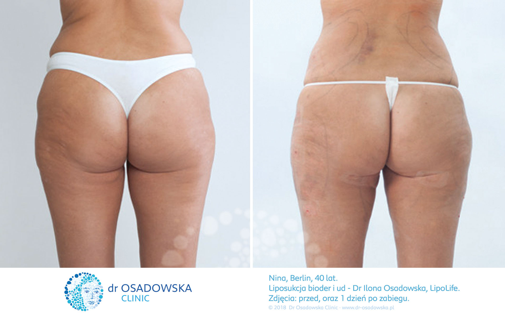 Liposukcja bioder, ud zdjęcia przed i po, efekty 1. dnia po zabiegu. Lipolife, laserowa, Dr Ilona Osadowska