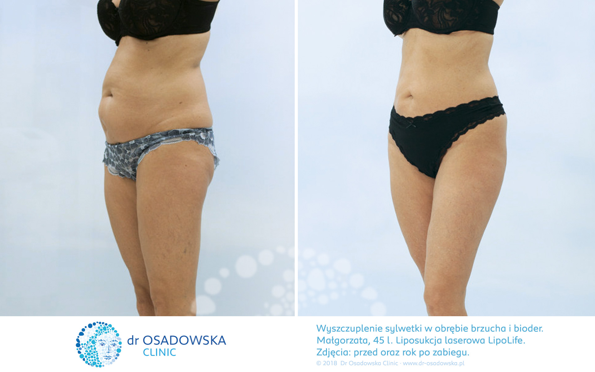 Liposukcja brzucha i talii, zdjęcia efekty przed, rok po zabiegu. Dr Ilona Osadowska, LipoLife