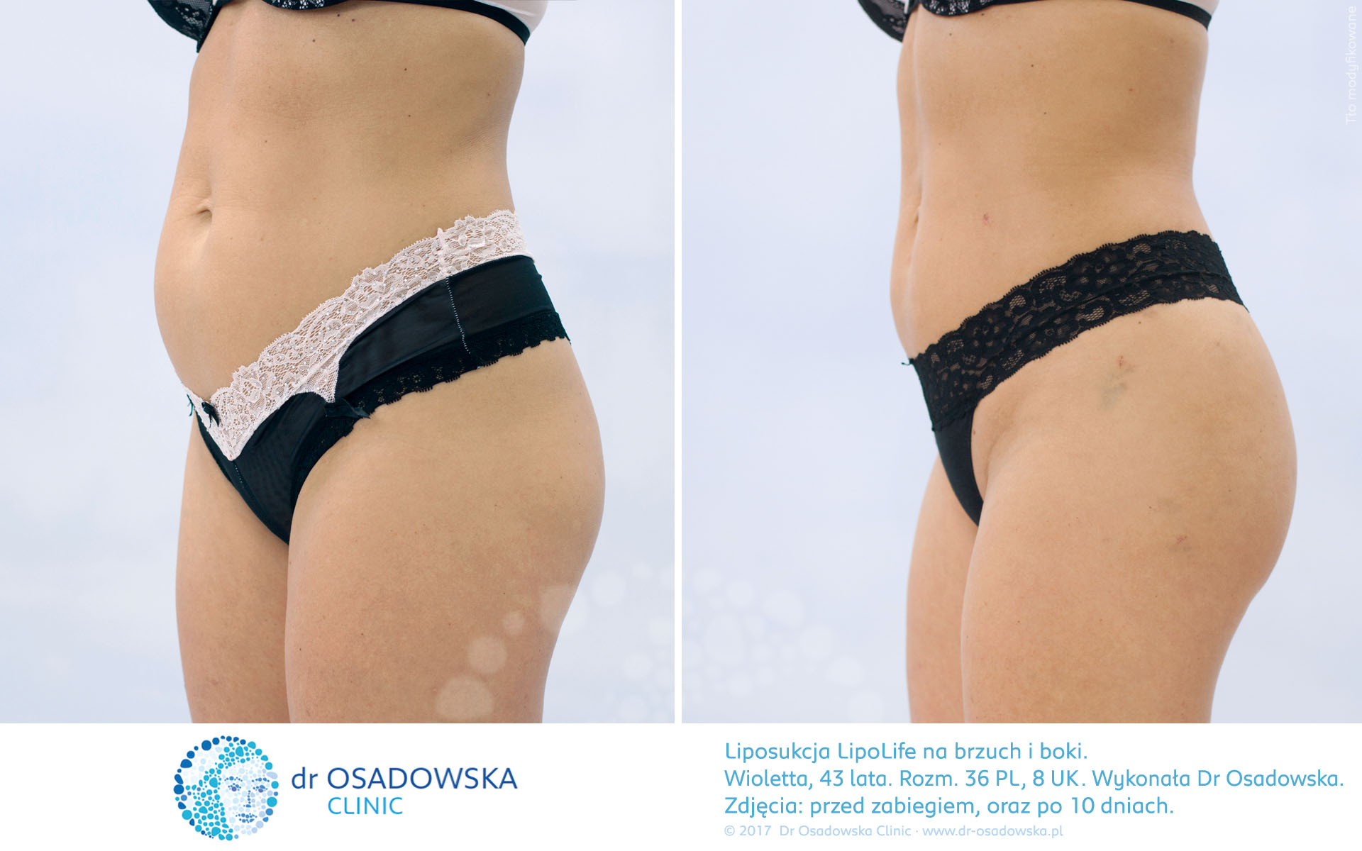 Liposukcja brzucha, zdjęcia efekty przed i po zabiegu (10 dni). Dr Osadowska, laserowa LipoLife