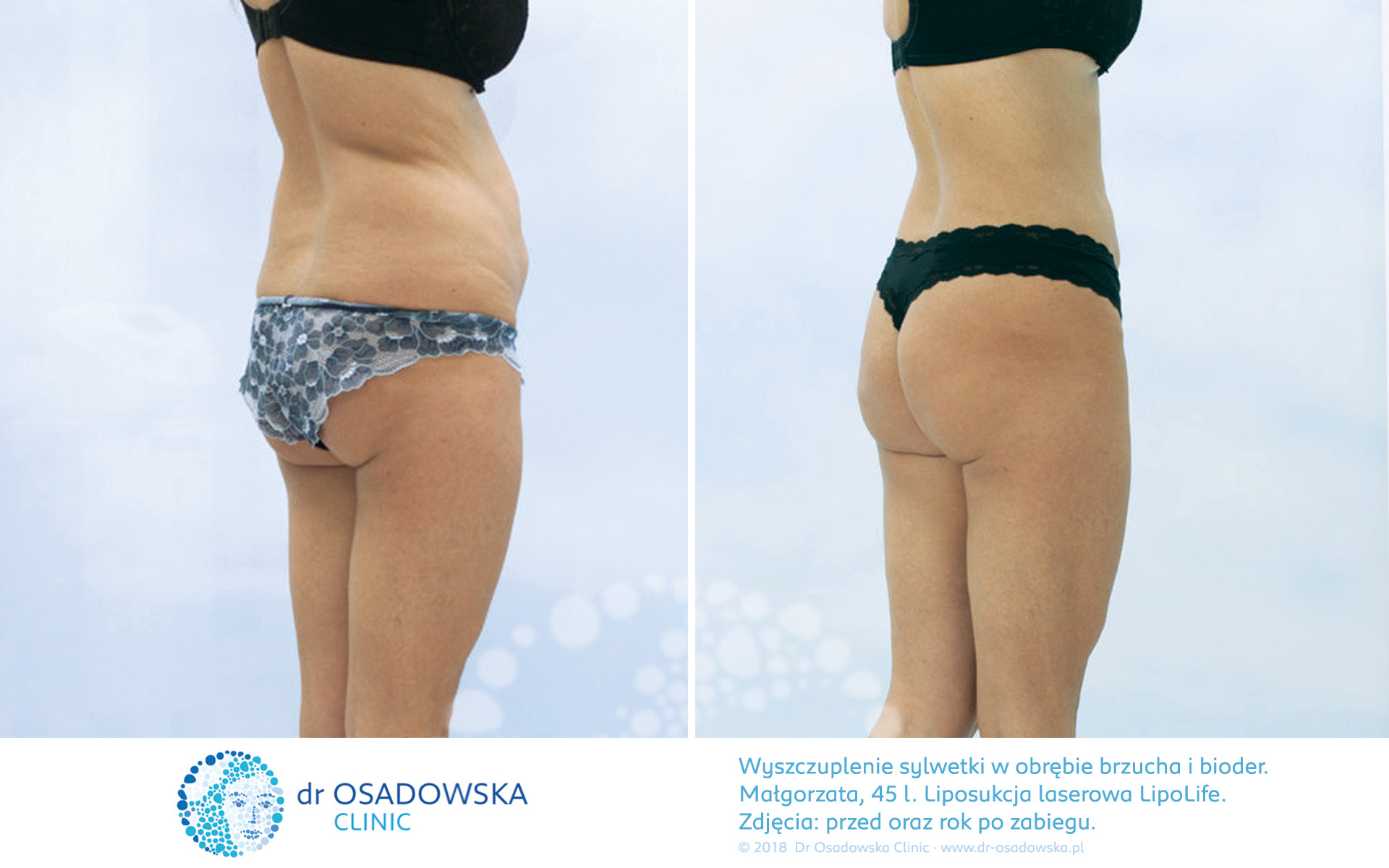 Liposukcja bioder i brzucha, zdjęcia efekty przed i rok po zabiegu Lipolife, Dr Ilona Osadowska
