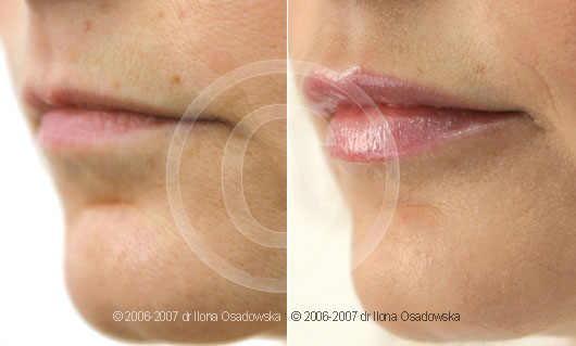 Powiększenie i modelowanie ust Restylane Lipp