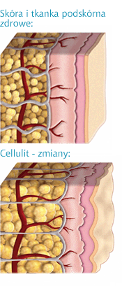 Cellulit