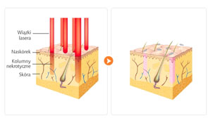 laser frakcyjny działanie