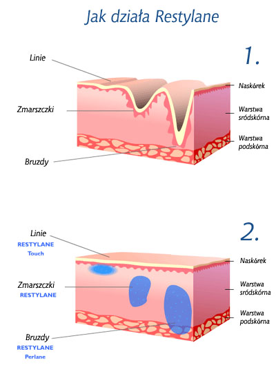 restylane działanie